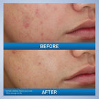 PanOxyl Acne Foaming Wash Benzoyl Peroxide 10% 156g