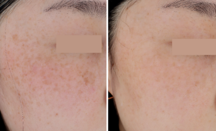 TG Dominas Whitening Cream RX (Freckles Care & Blemish Care) 50g