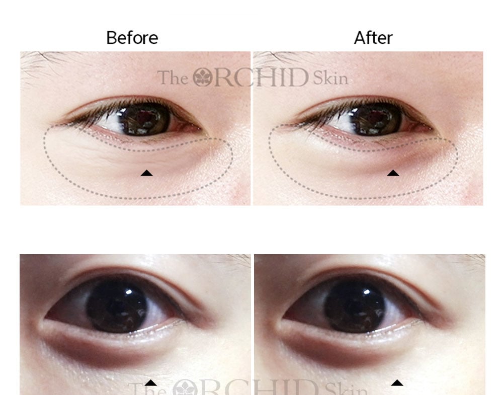 The Orchid Skin Orchid ELASTIC Under Clear Eye Patch (Improve Fine Lines And Slack) 10 pairs