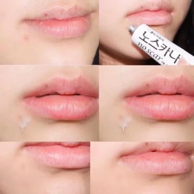 Dong-A Pharm Noscarna Scar Gel (Treat Keloid, Surgery & Acne Scars) 20g