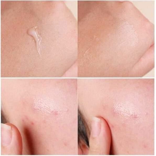 Dong-A Pharm Noscarna Scar Gel (Treat Keloid, Surgery & Acne Scars) 20g