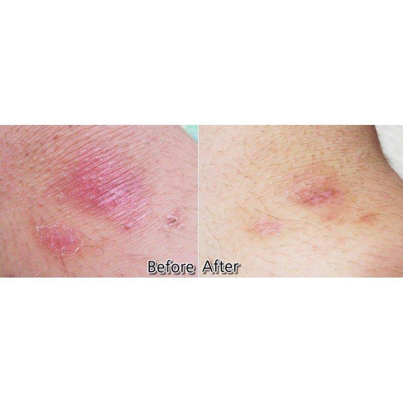 Dong-A Pharm Noscarna Scar Gel (Treat Keloid, Surgery & Acne Scars) 20g
